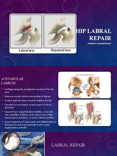 Hip Labral Disorders 